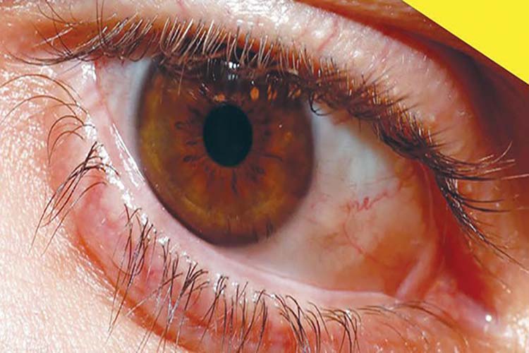 La retinopatía diabética es la segunda causa de ceguera