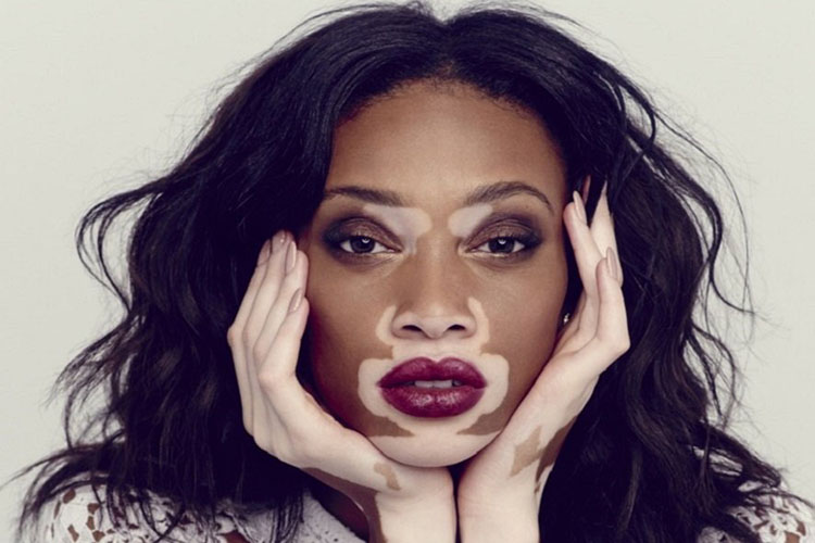El vitiligo es un problema de pigmentación controlable, asegura especialista