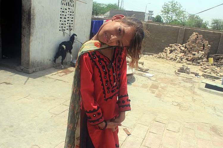 En Pakistán: Misterioso caso de una niña con el cuello doblado