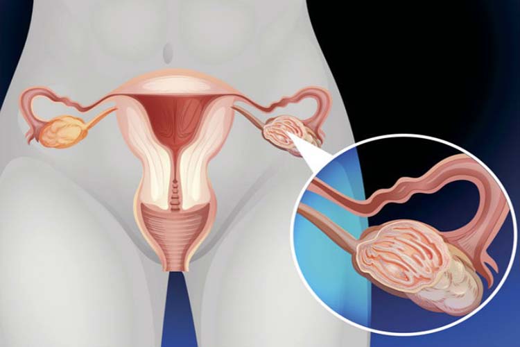 El cáncer de ovario podría confundirse con una colitis