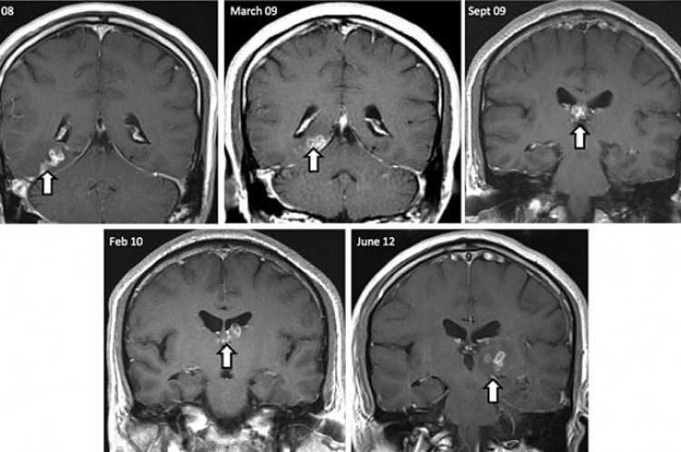 Cirujanos extirpan a un hombre parásito que comió su  cerebro durante 15 años