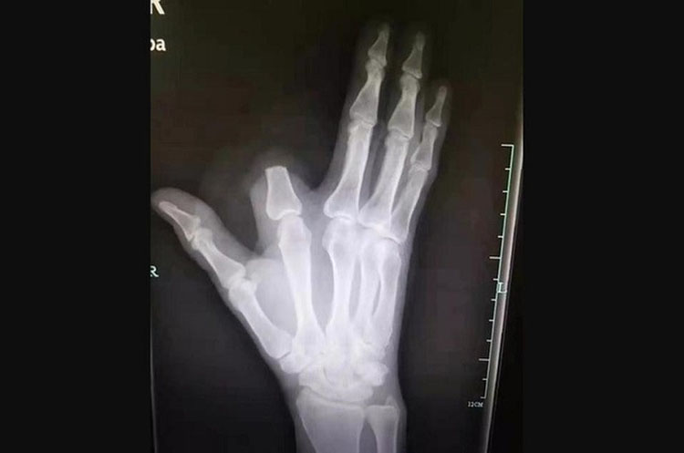 Se amputó el dedo porque lo mordió una serpiente y los médicos  dijeron ¡fue innecesario!