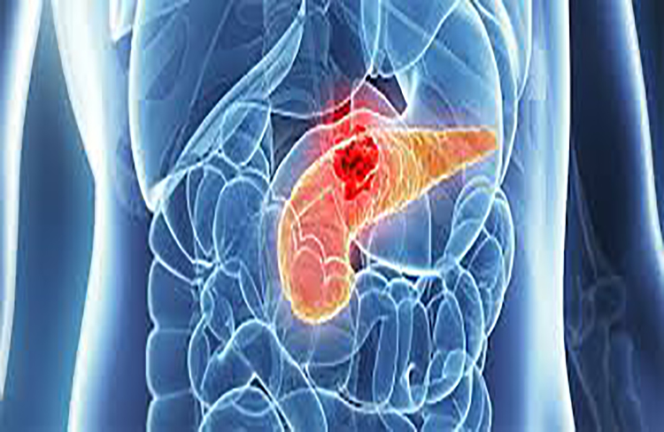 Investigadores encuentran una nueva forma de tratar el cáncer de páncreas
