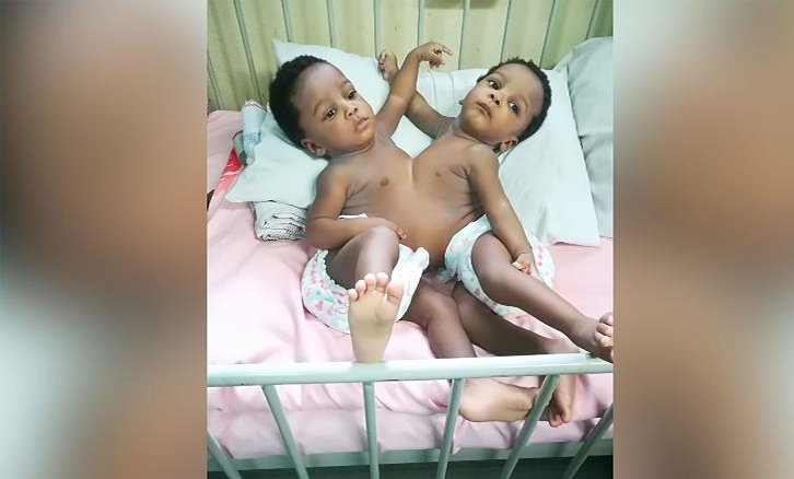 Siamesas fueron separadas en hospital de Nigeria