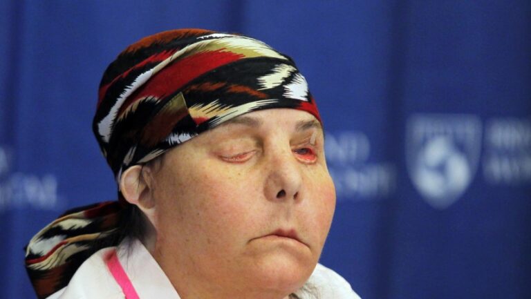 La primera persona en recibir dos trasplantes de cara en EEUU muestra su rostro