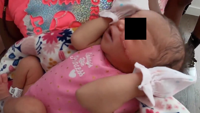 Cortaron la cara de una recién nacida durante cesárea de emergencia