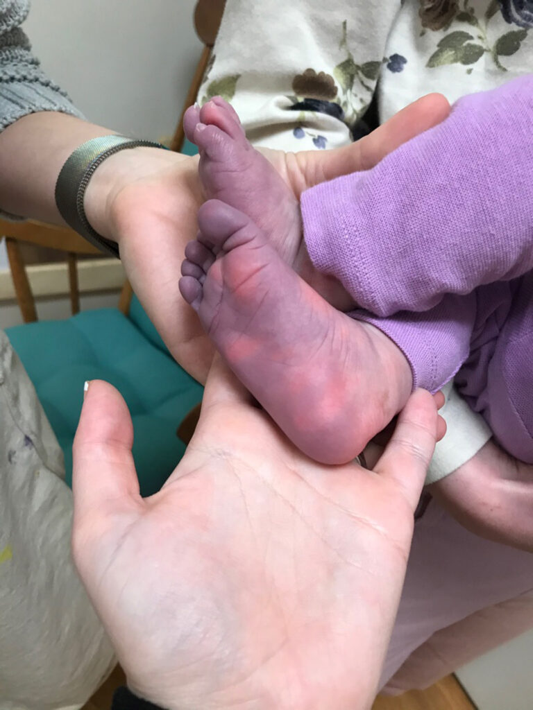 Una bebé terminó con las manos y pies morados tras padecer covid