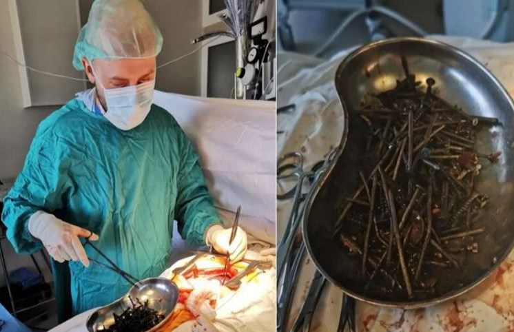 Médicos encuentran un kilo de clavos y tornillos en estómago de paciente