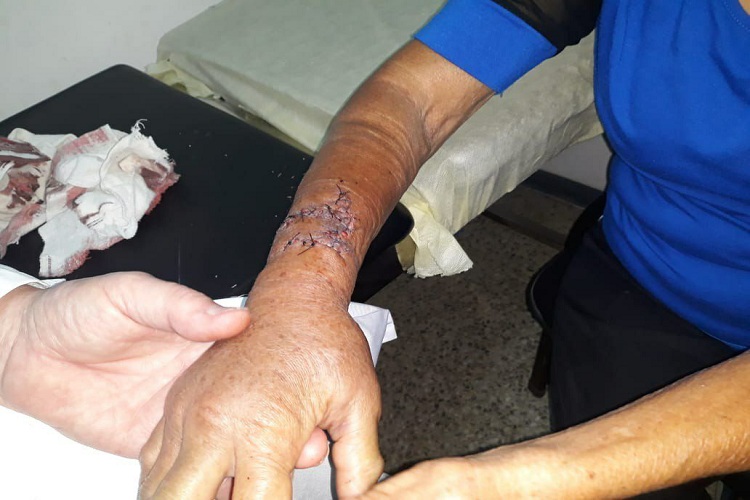 Una abuela casi pierde el brazo al ser atacada por un perro en Caricuao