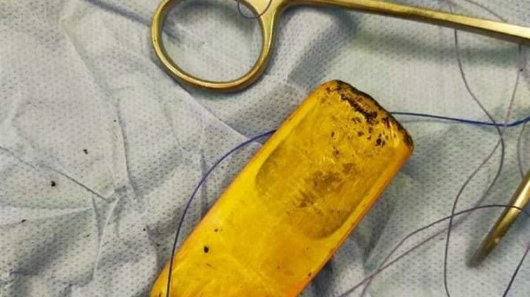 Un recluso en Egipto tuvo un celular en su estómago durante seis meses