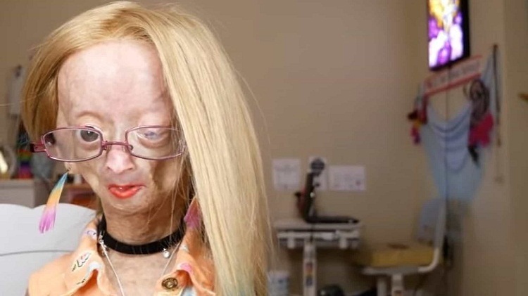 Muere Adalia Rose Williams la youtuber que inspiró la película de Benjamin Button