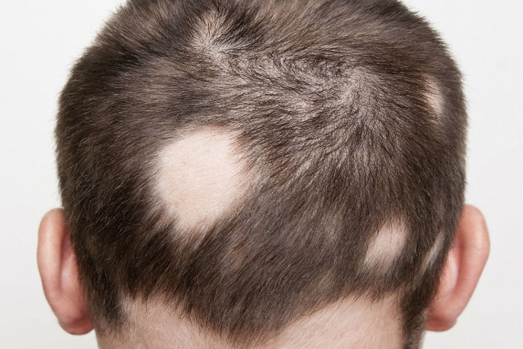 «Alopecia», el nuevo síntoma estético y visible después del contagio de la Ómicron