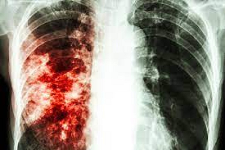 Ministerio de Salud devela cuáles son los estados con más tuberculosis