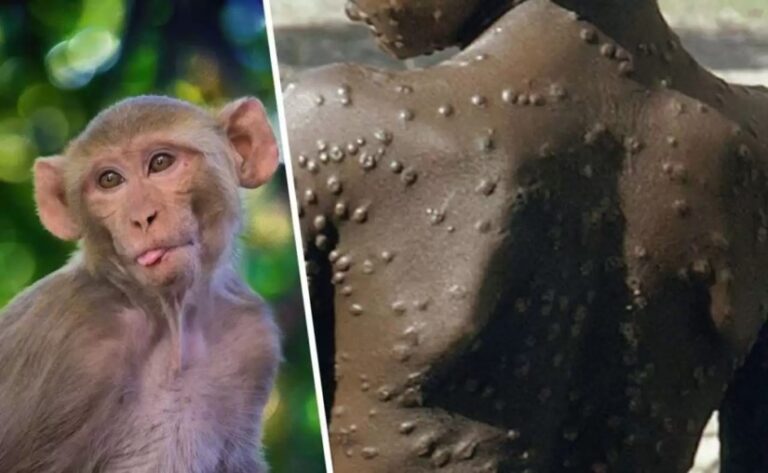 Aseguran que riesgo de contagio de la viruela del mono es «muy bajo»