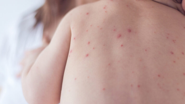 Médicos advierten que «en Venezuela hay un brote endémico de varicela»