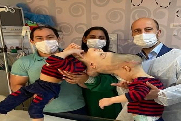 Cirugía que separó a siameses en Brasil será ofrecida gratuitamente a otros niños de América Latina