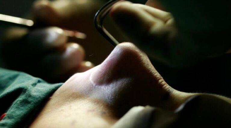 Brasil: Hombre intenta practicarse una cirugía estética en su nariz siguiendo tutorial en Youtube